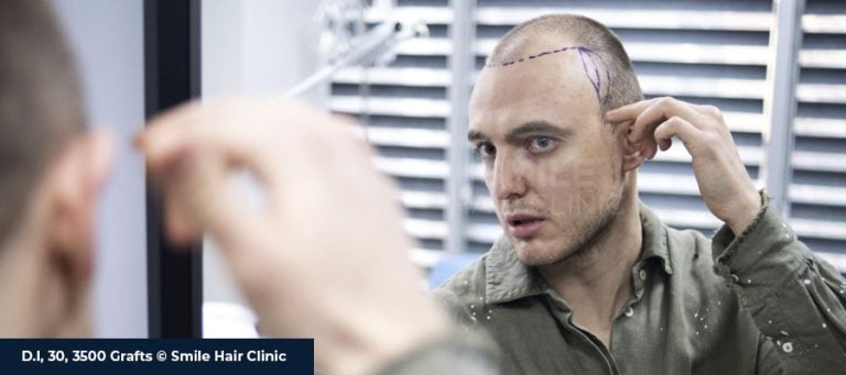 Ways to Prevent Hair Loss, and Hair Care