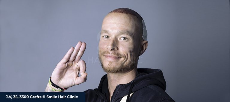 How to Choose the Right Hair Transplantation Center in Turkey?