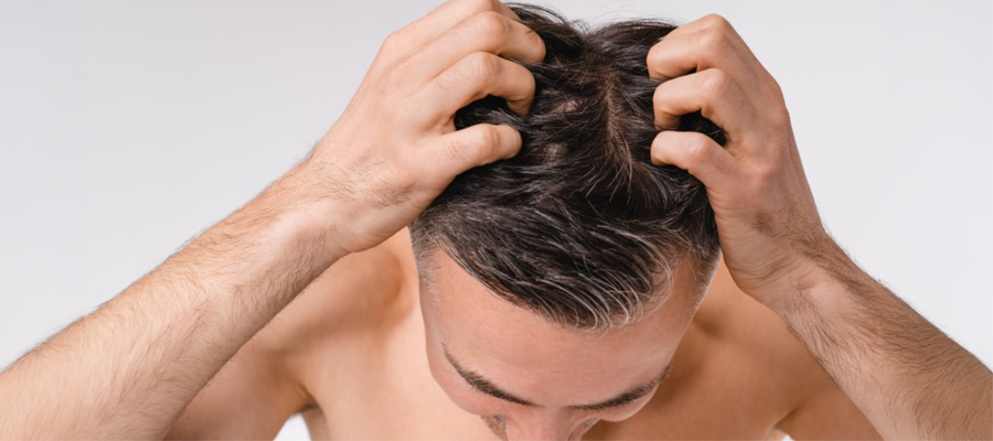 Hair Loss in Men 2 Hair Loss in Men