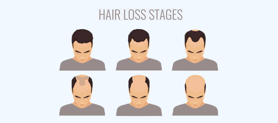 Hair Loss in Men 3 Hair Loss in Men
