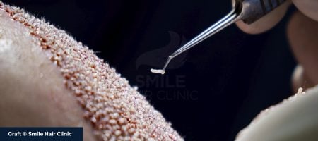 ROLE A GRAFT IN HAIR TRANSPLANT
