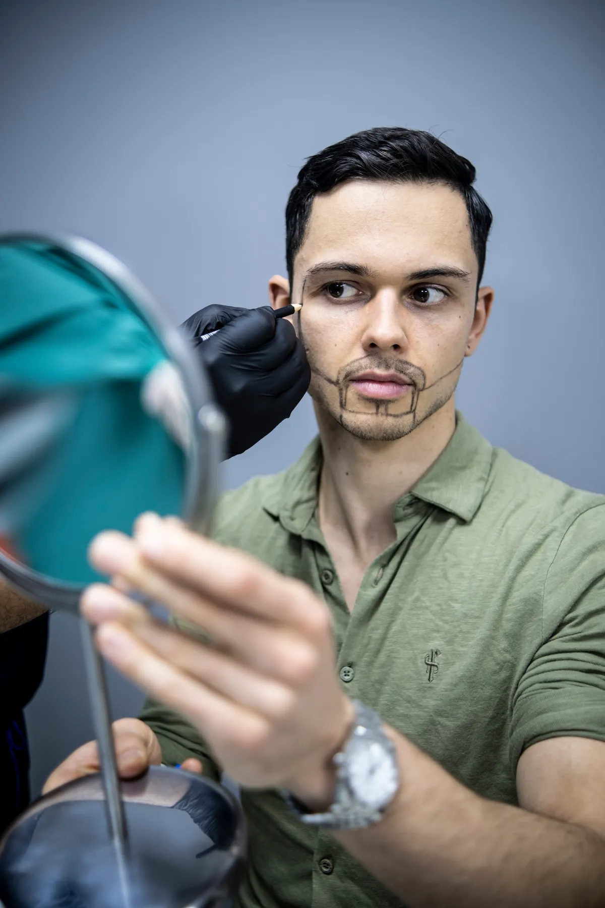 Przeszczep brody 3 Beard Transplant Techniques at Smile Hair Clinic