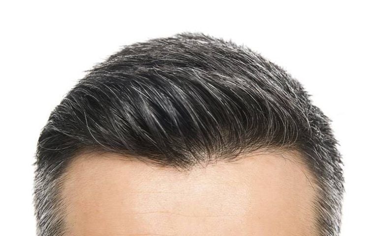 DIE BESTE HAARTRANSPLANTATION