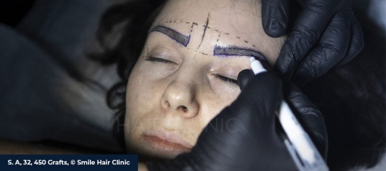 Eyebrow Transplant