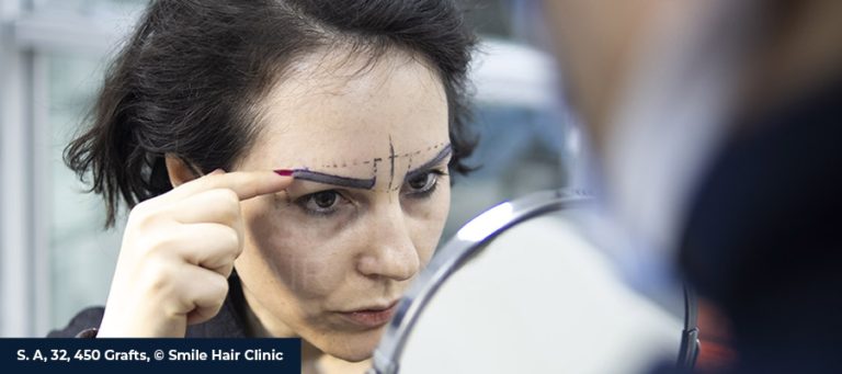 Трансплантация бровей