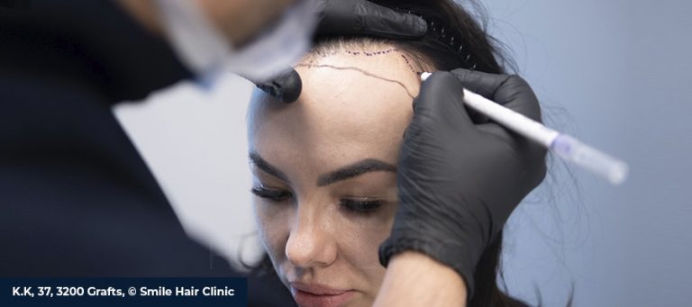 Can Women Get Hair Transplants? Female Hair Restoration Guide 4 Can Women Get Hair Transplants? Female Hair Restoration Guide