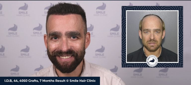 Haartransplantation Vorher-Nachher-Bilder