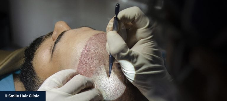 Manuelle Fue-Haartransplantation