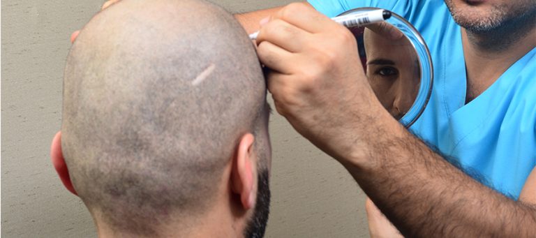 prima delloperazione di trapianto di capelli