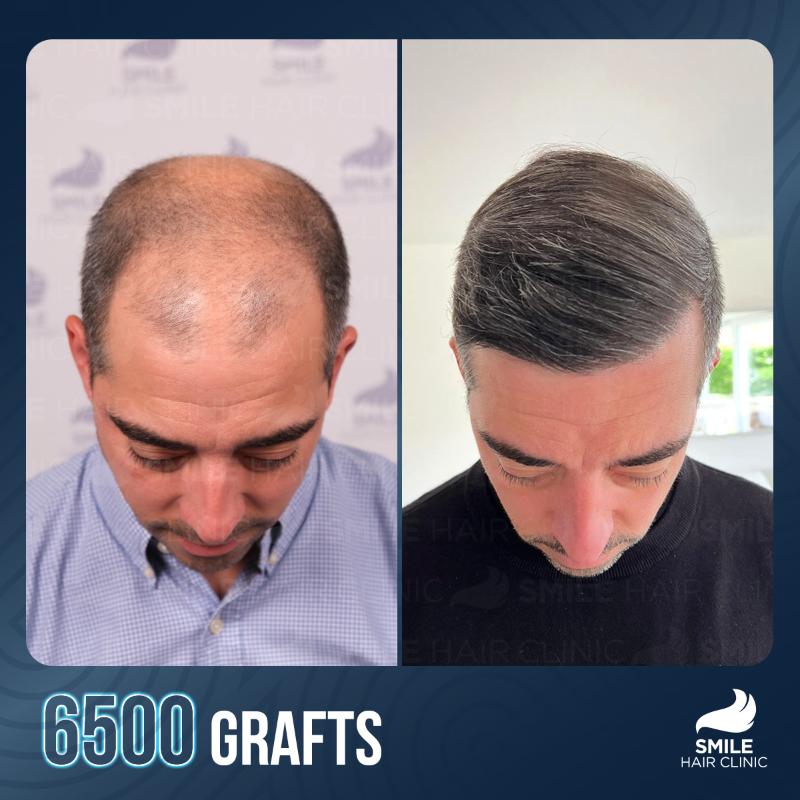 hair transplant turkey cost