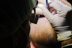 OPÈRATION DE TRANSPLANTATION CAPILLAIRE 1 OPÈRATION DE TRANSPLANTATION CAPILLAIRE