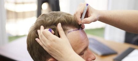 lavaggio-dei-capelli-operazione-di-trapianto-di-capelli