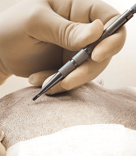 FUE HAARTRANSPLANTATION