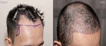 NACH DER HAARTRANSPLANTATION