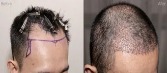 NACH DER HAARTRANSPLANTATION