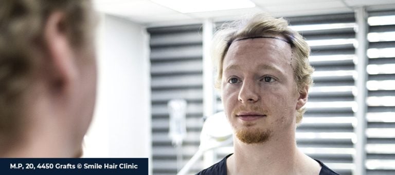 Hair Transplant Correction