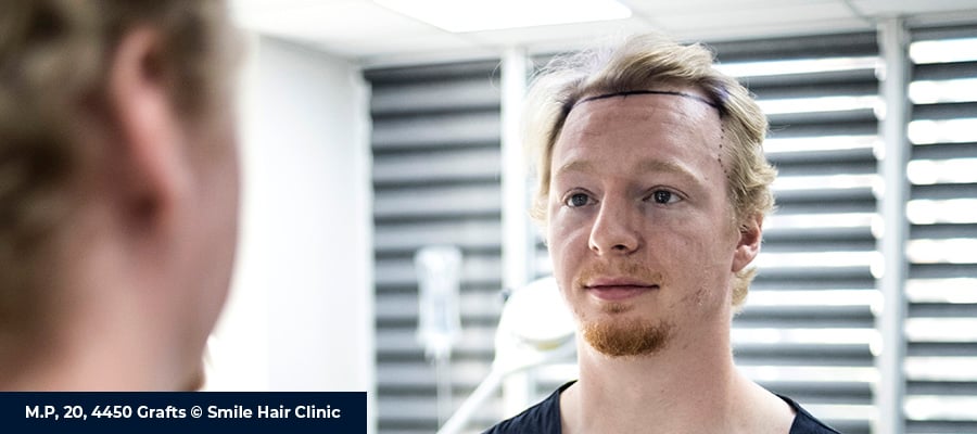 Hair Transplant Correction