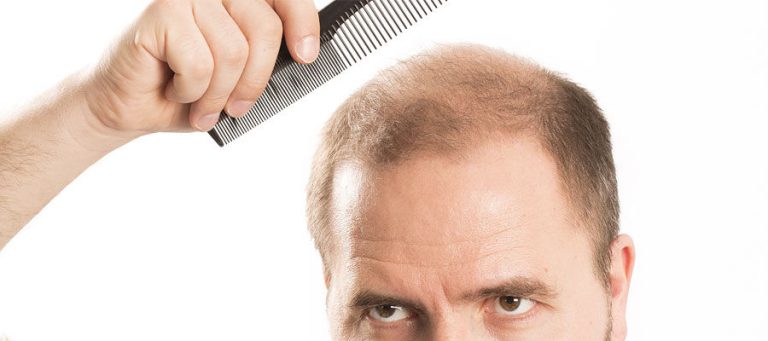 LA GREFFE DE CHEVEUX EST-ELLE EFFICACE