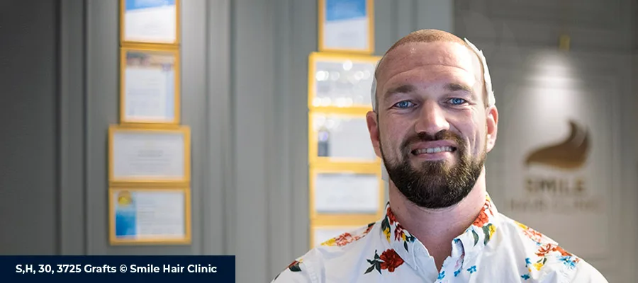 Panthenol Spray After Hair Transplant When to Start, How to Use & Timeline