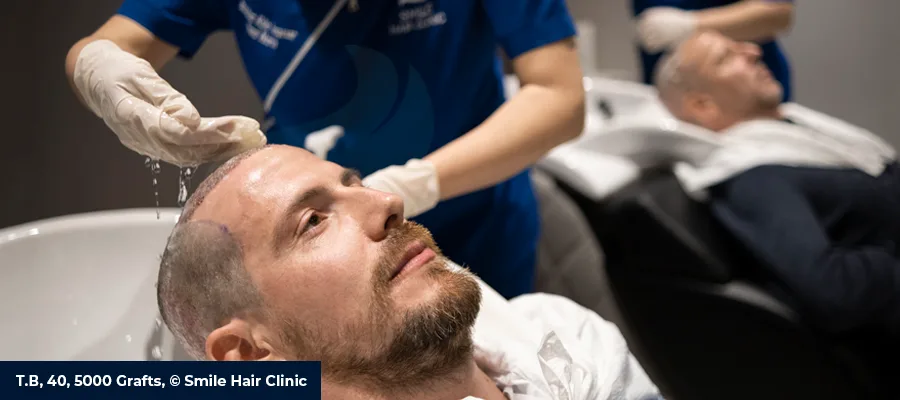 10 Days After Hair Transplant: Day 10 Healing, Washing, Scabs