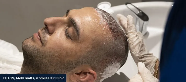 Panthenol Spray After Hair Transplant When to Start, How to Use & Timeline