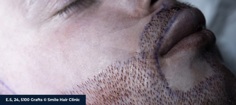 Moustache Transplant 1 Moustache Transplant