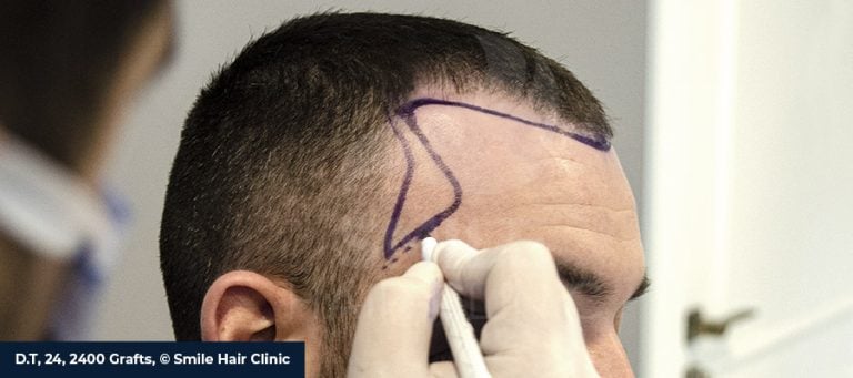 Sideburn Transplantation