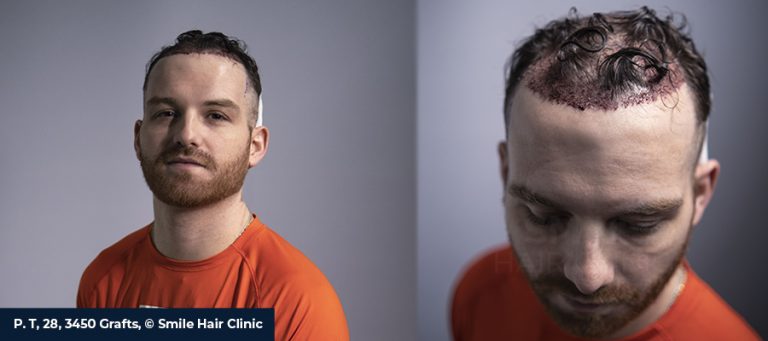 Unshaven Hair Transplant