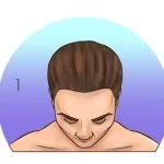 Norwood-Hamilton Ölçeği