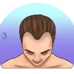 Norwood-Hamilton Ölçeği