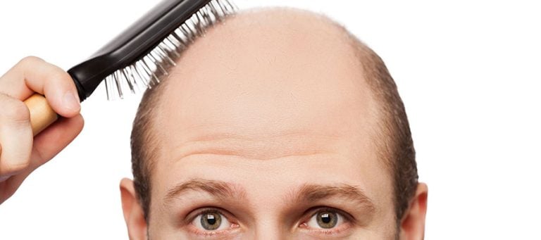 Norwood-Hamilton Ölçeği