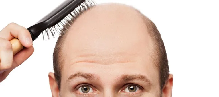 Norwood-Hamilton Ölçeği