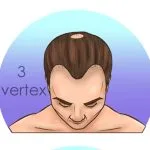 Norwood-Hamilton Ölçeği