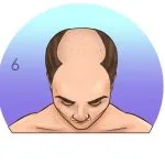 Norwood-Hamilton Ölçeği