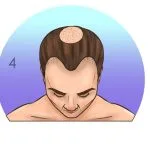 Norwood-Hamilton Ölçeği