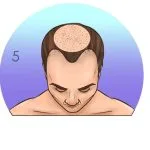 Norwood-Hamilton Ölçeği