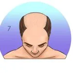 Norwood-Hamilton Ölçeği