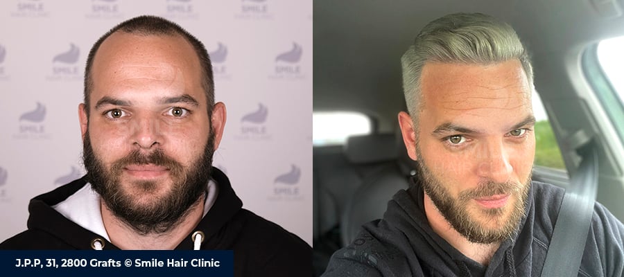 Best Hair Transplant in the World 1 Best Hair Transplant in the World