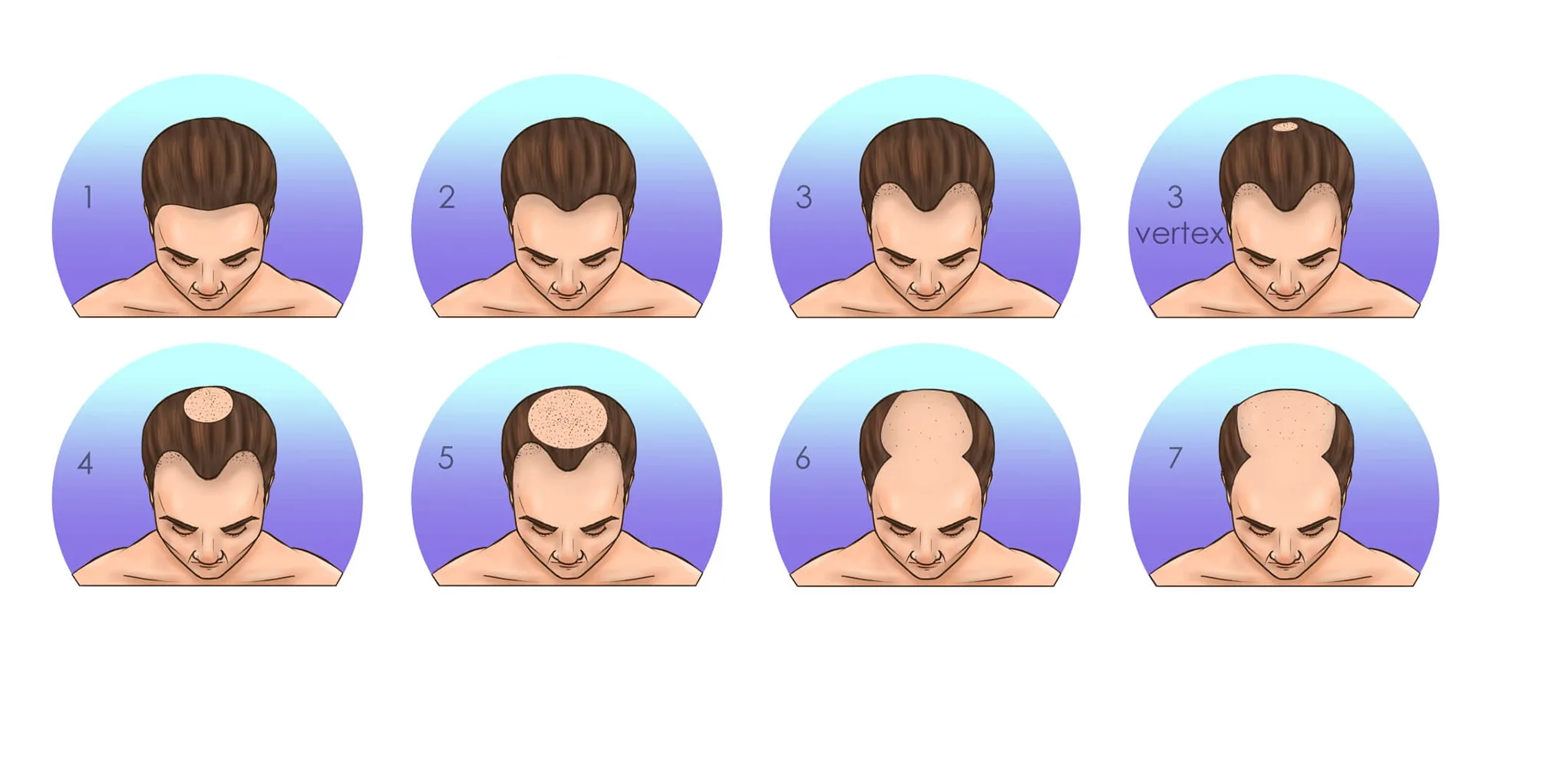 Norwood-Hamilton Ölçeği