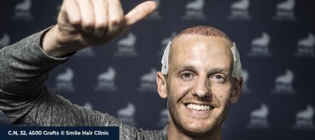 DOES HAIR TRANSPLANT WORK