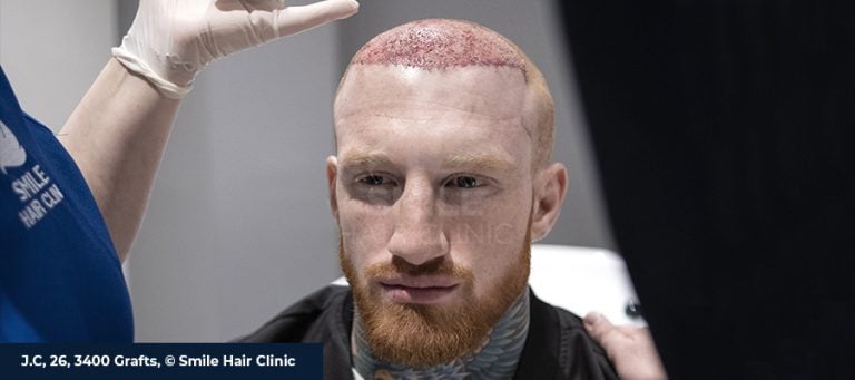 Побочные эффекты трансплантации волос