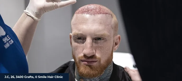 الآثار الجانبية لزراعة الشعر