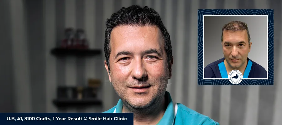 Types of Hair Transplant: FUE vs FUT vs DHI & Sapphire FUE Guide