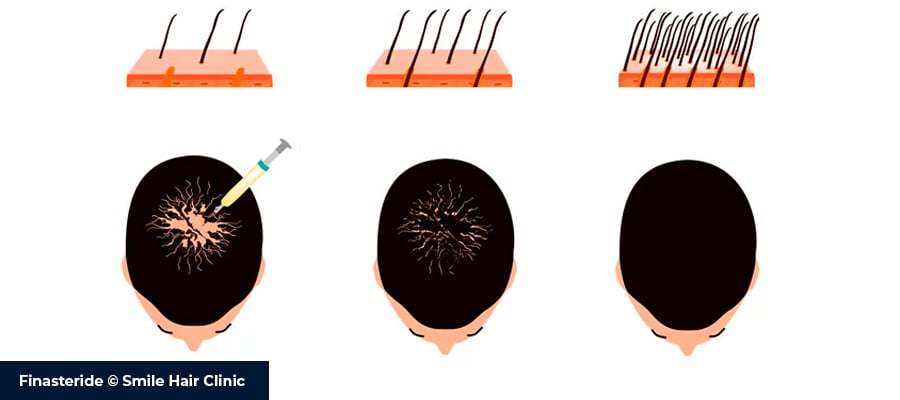 Tutto sulla Finasteride