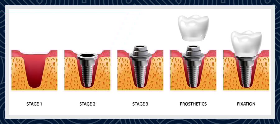 Dental Implants in Turkey 1 Dental Implants in Turkey