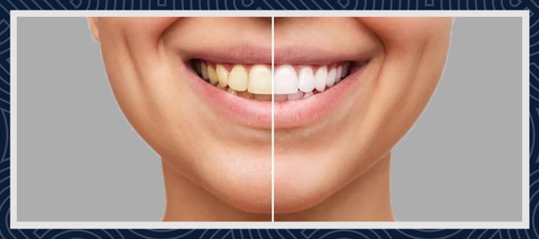 Teeth whitening before and after