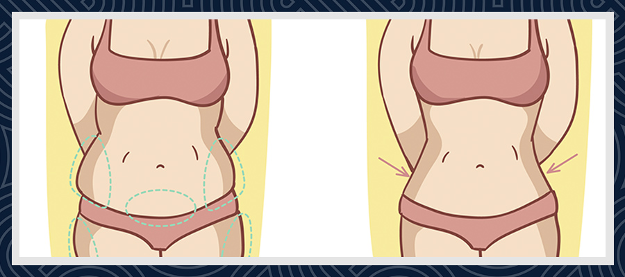 Gastric Sleeve i Tyrkiet