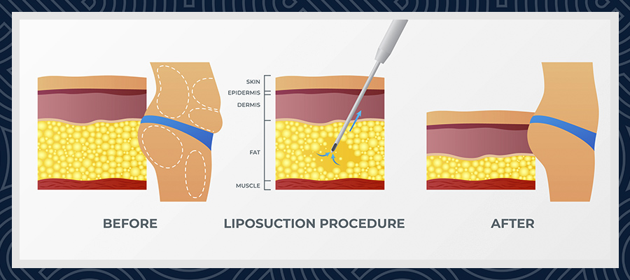 What is Liposuction Turkey?