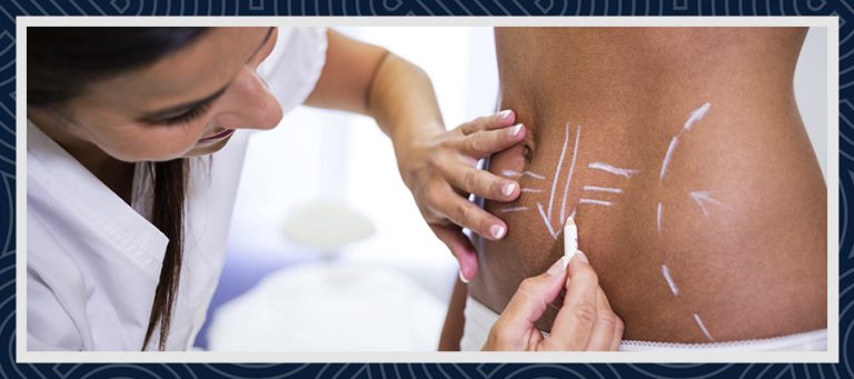 What is Liposuction Turkey?