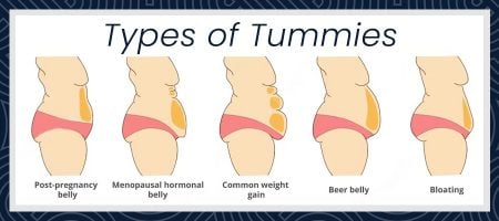 Tummy Tuck